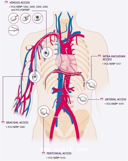 法國貝魯斯植入式中心靜脈導(dǎo)管（化療泵）